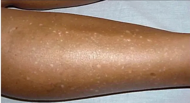 White Spots On Legs: What Causes Them And How To Get Rid Of Them