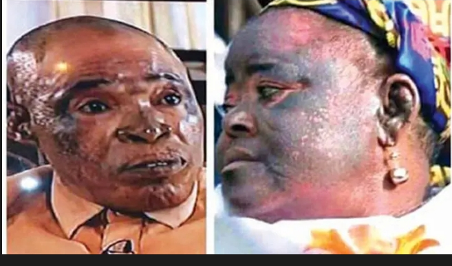 Dangers of bleaching, whitening creams